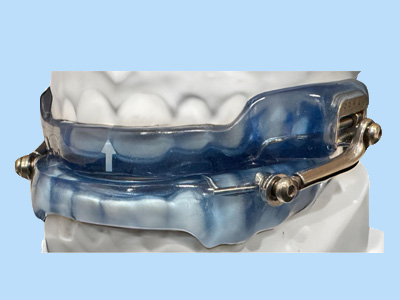 An image of a dental implant with a blue crown, showcasing the prosthetic tooth and its attachment to a metal framework.