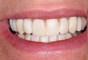 A person is smiling with a bright white smile, showcasing their teeth and gums.