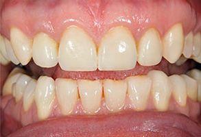 The image displays a close-up of a person s teeth, showing yellowish staining and the upper lip with a pinkish hue.
