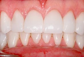 The image shows a close-up of a person s teeth, with the focus on the lower front teeth which appear to be in need of dental treatment.