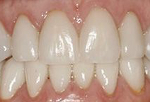 The image shows a close-up of a person s mouth with visible teeth and gums, focusing on the dental work which includes a bridge or partial denture.