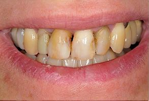 An image of a person s teeth with visible yellow staining, possibly due to nicotine or other causes.