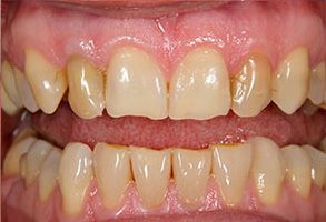 The image shows a close-up of a person s teeth with a focus on the lower front teeth, which appear to be discolored and possibly in need of dental care.
